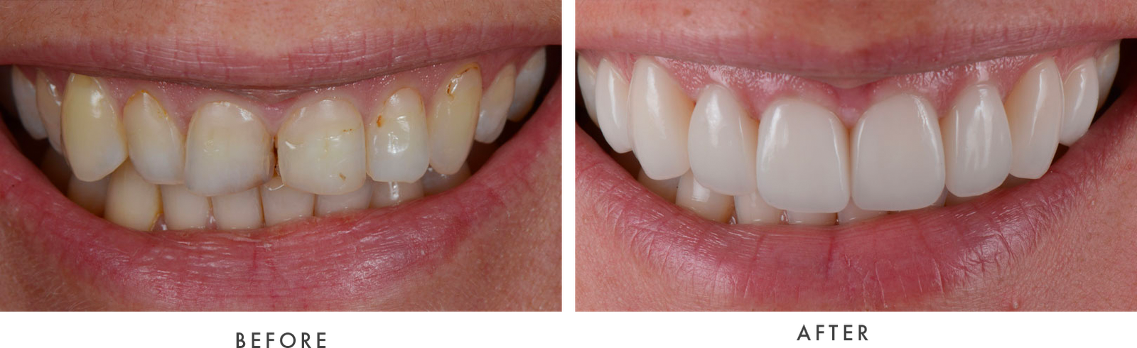 Porcelain Veneers