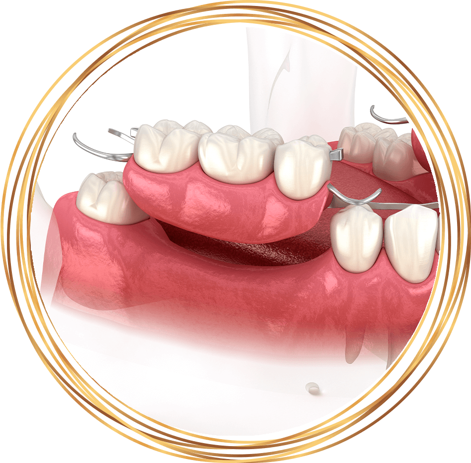 partial denture 3d rendering