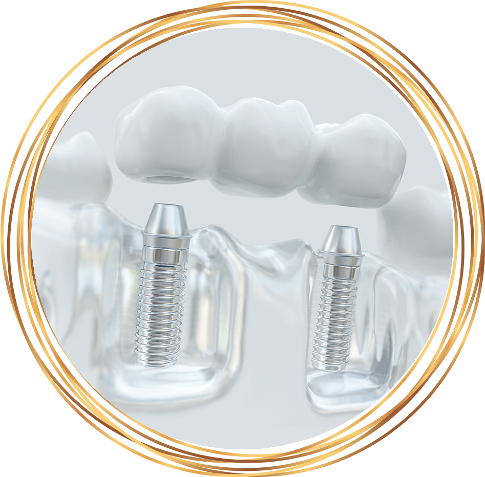 dental implant bridge
