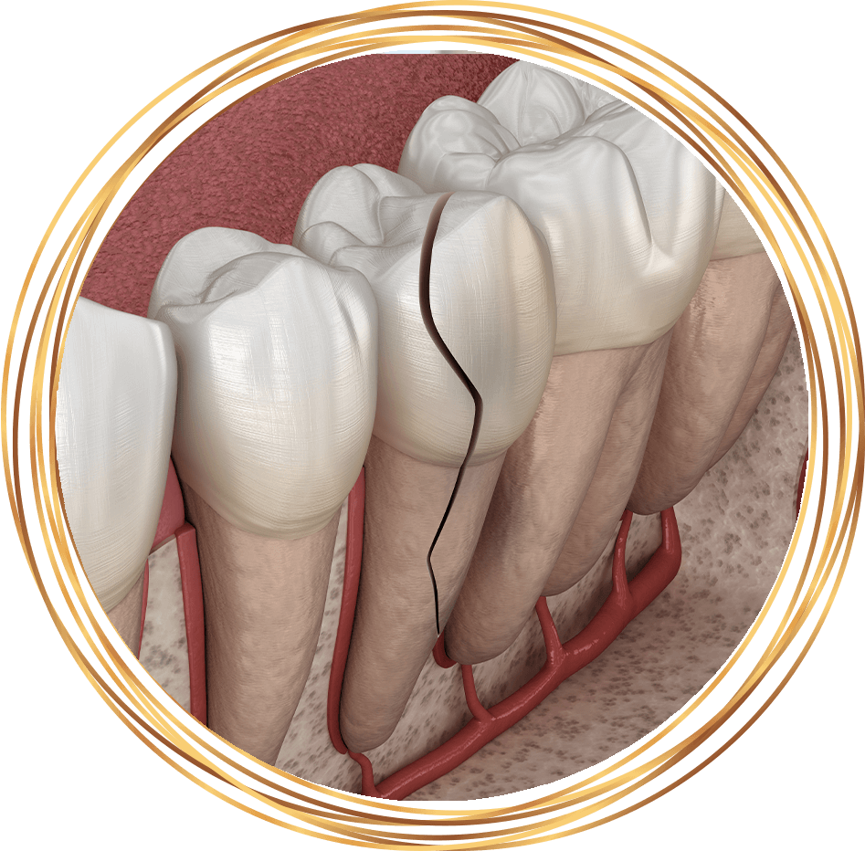 cracked tooth 3d rendering