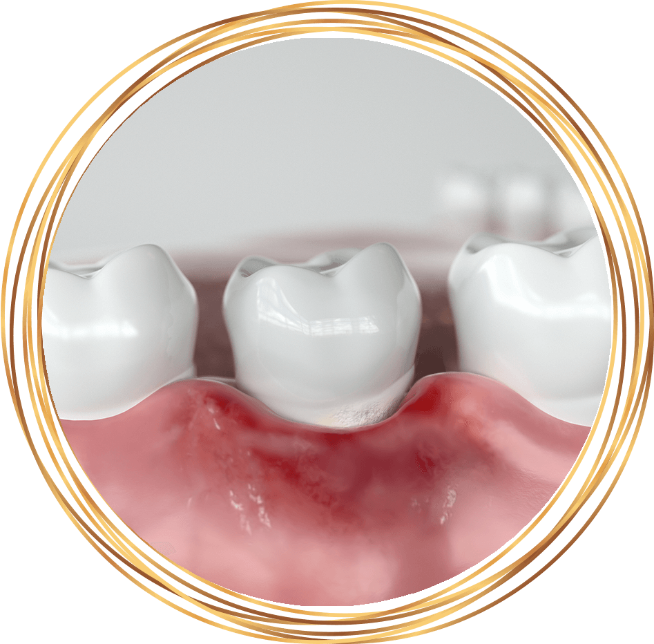 inflamed and red gums