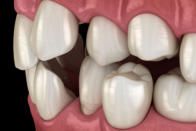 crooked teeth malocclusion