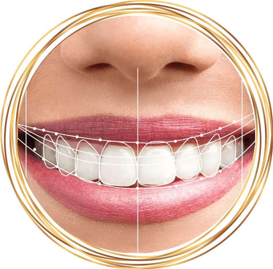 dental patient smiling with lines on teeth indicating measurements