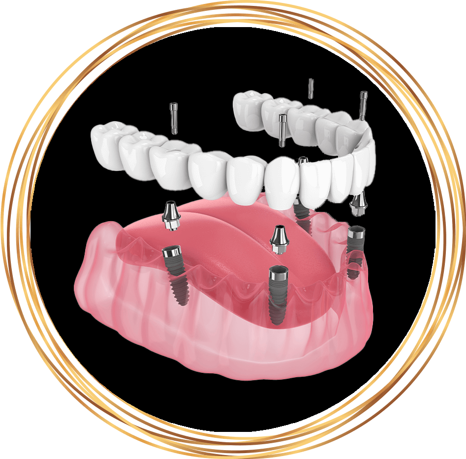all on 4 fixed dental implants