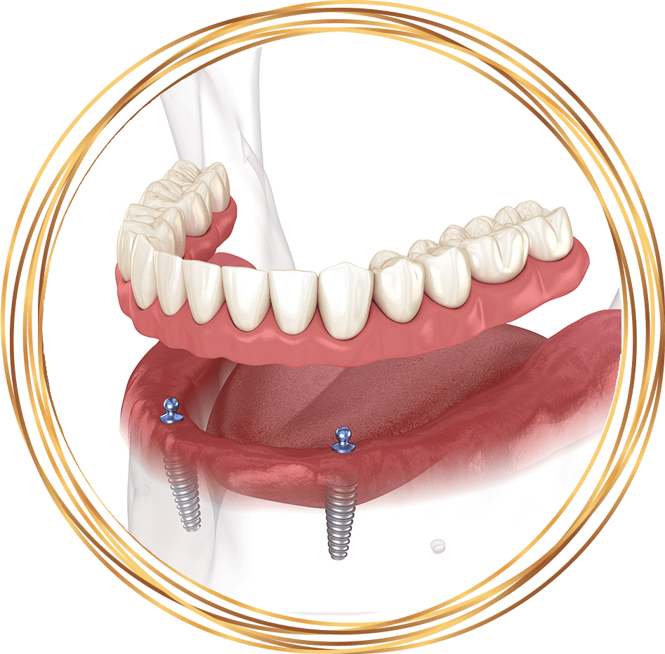 implant supported denture